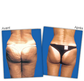home-lipomassage-before-after