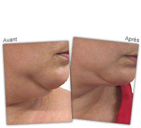 home-endermolift-before-after